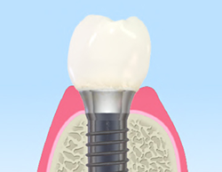 インプラント