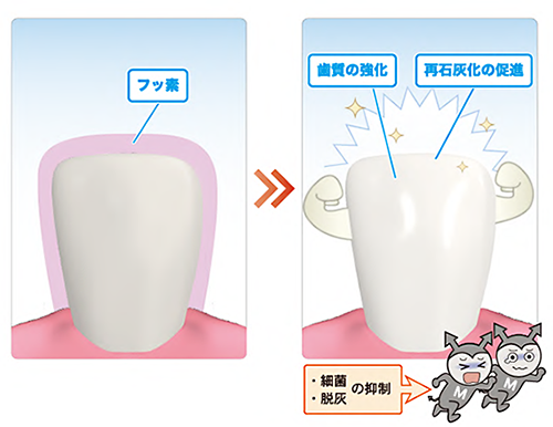 フッ素塗布