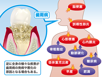 歯周病と全身疾患との関係